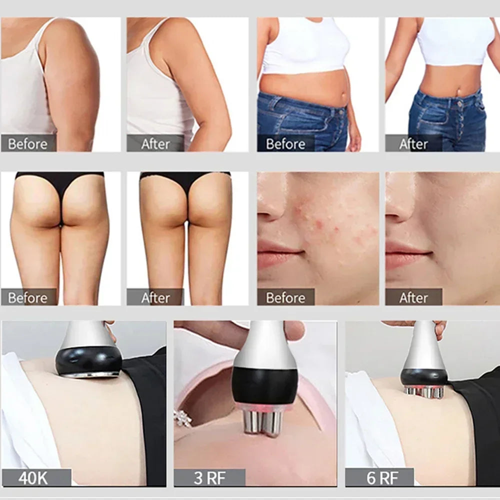 Beemyi 40K Ultrasonic Cavitation Machine for Body Slimming